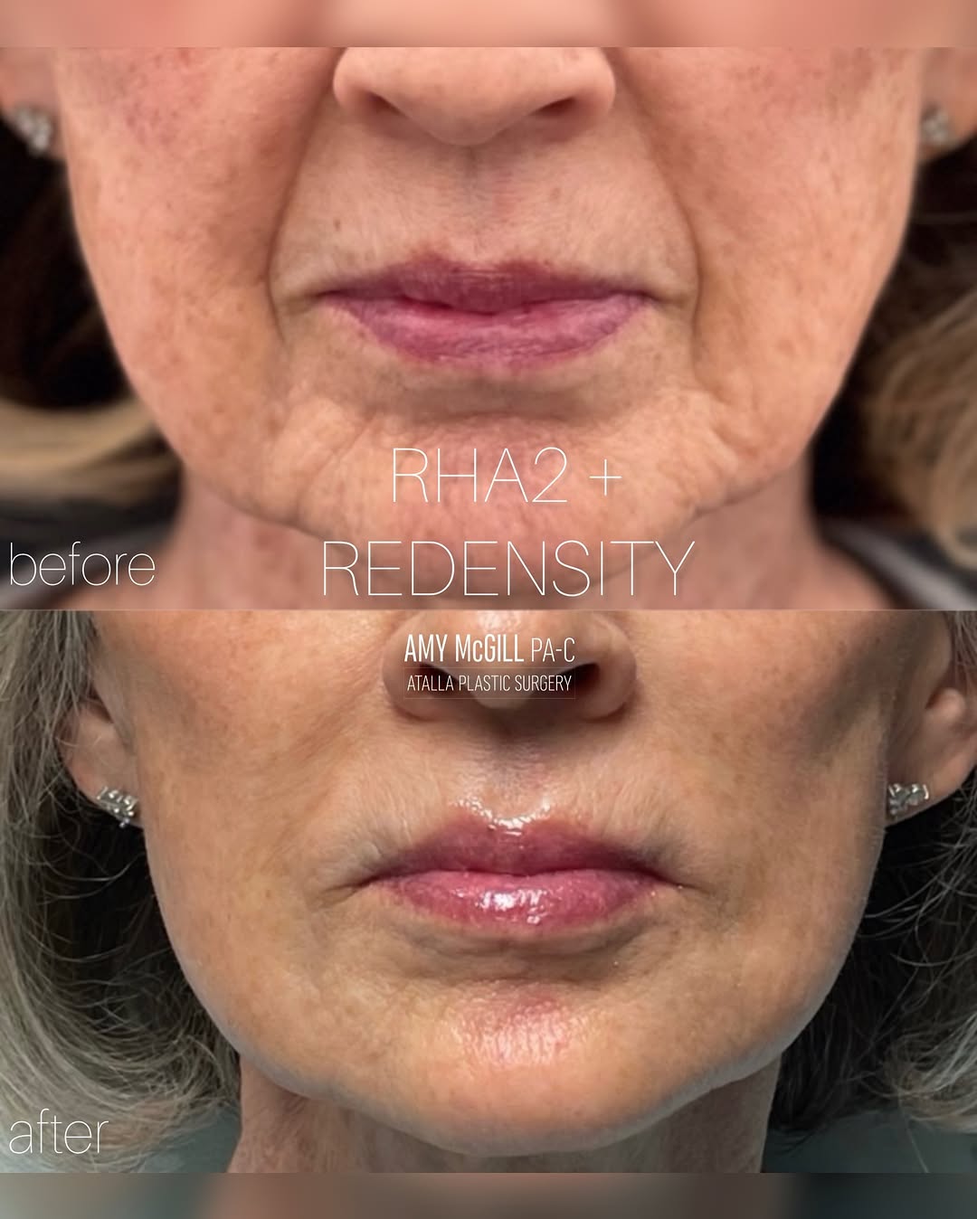 Instagram post by Dr. Katie Durnen: Your holiday countdown starts now… ✨ This beautiful before + after by Amy McGill, PA-C, was achieved using RHA® 2 and RHA® Redensity™ for a …