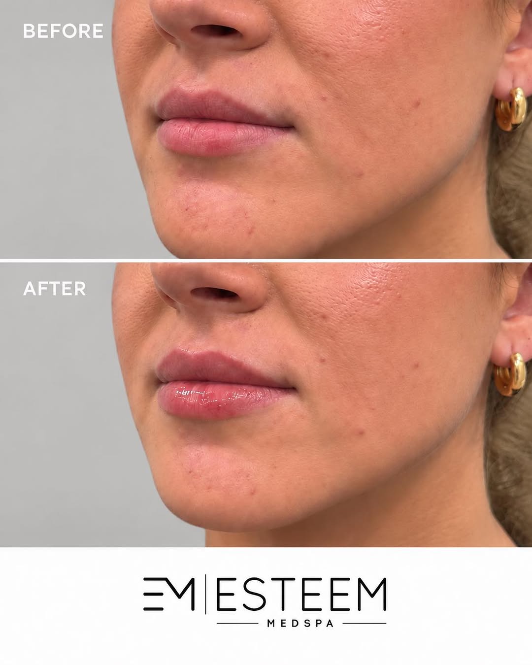Instagram post by Dr. Kaye Riolo: Subtle enhancement, beautiful results ✨💋 This lip transformation added the perfect touch of volume and definition while keeping her look so…