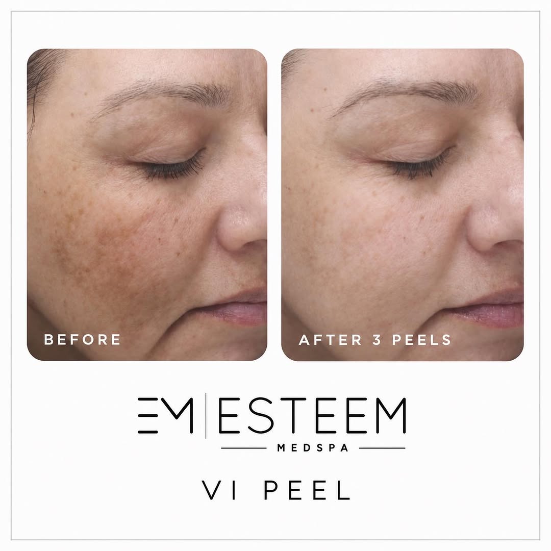 Instagram post by Dr. Kaye Riolo: The results speak for themselves ✨ After a series of 3 VI Peels, this beautiful transformation shows a brighter, smoother, and more even-loo…