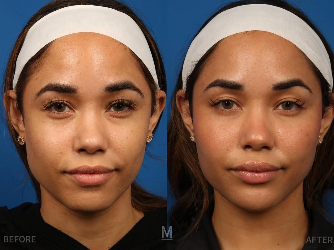 Instagram post by Dr. Keith A. Marcus: These before and after photos show our beautiful, young patient who wanted to feel more confident before her wedding in 3 months’ time. She …