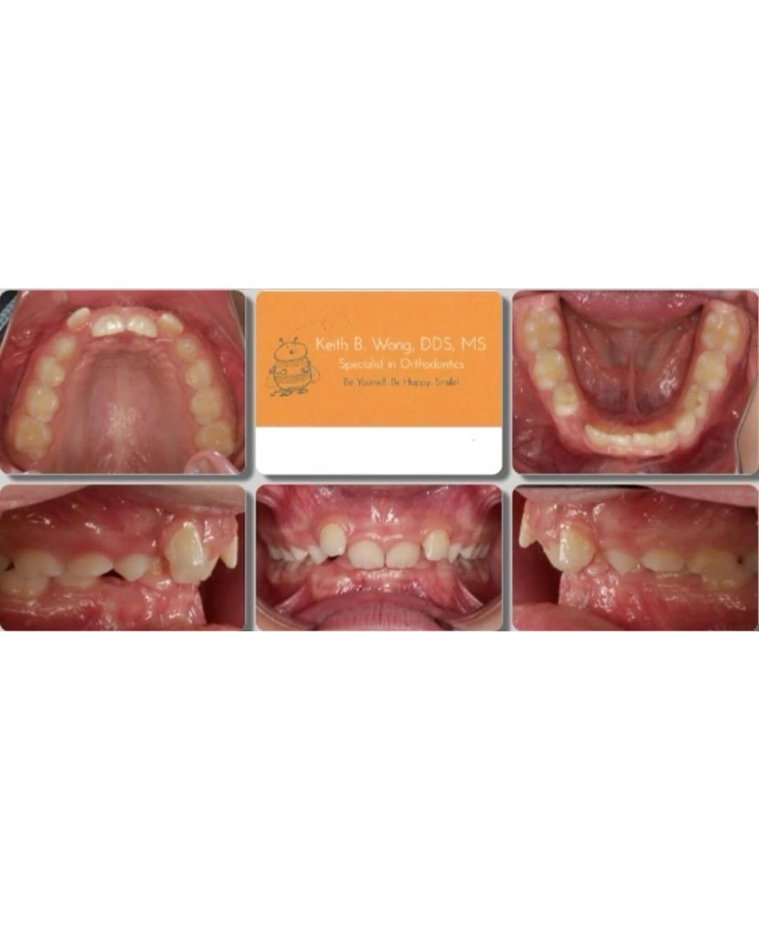Instagram post by Dr. Keith B. Wong, DDS, MS: Incredible before and after! From extreme over-jet to a perfect bite, our friend deserved it!!! 💙 Happy Thursday Bees 🐝 #orthodontist #sea…