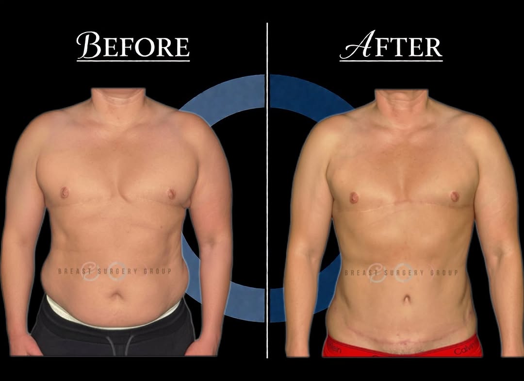 Instagram post by Dr. Keith M. Blechman: Body contouring is all about creating balance, improving proportion, and refining areas that may not respond the way you want despite health…