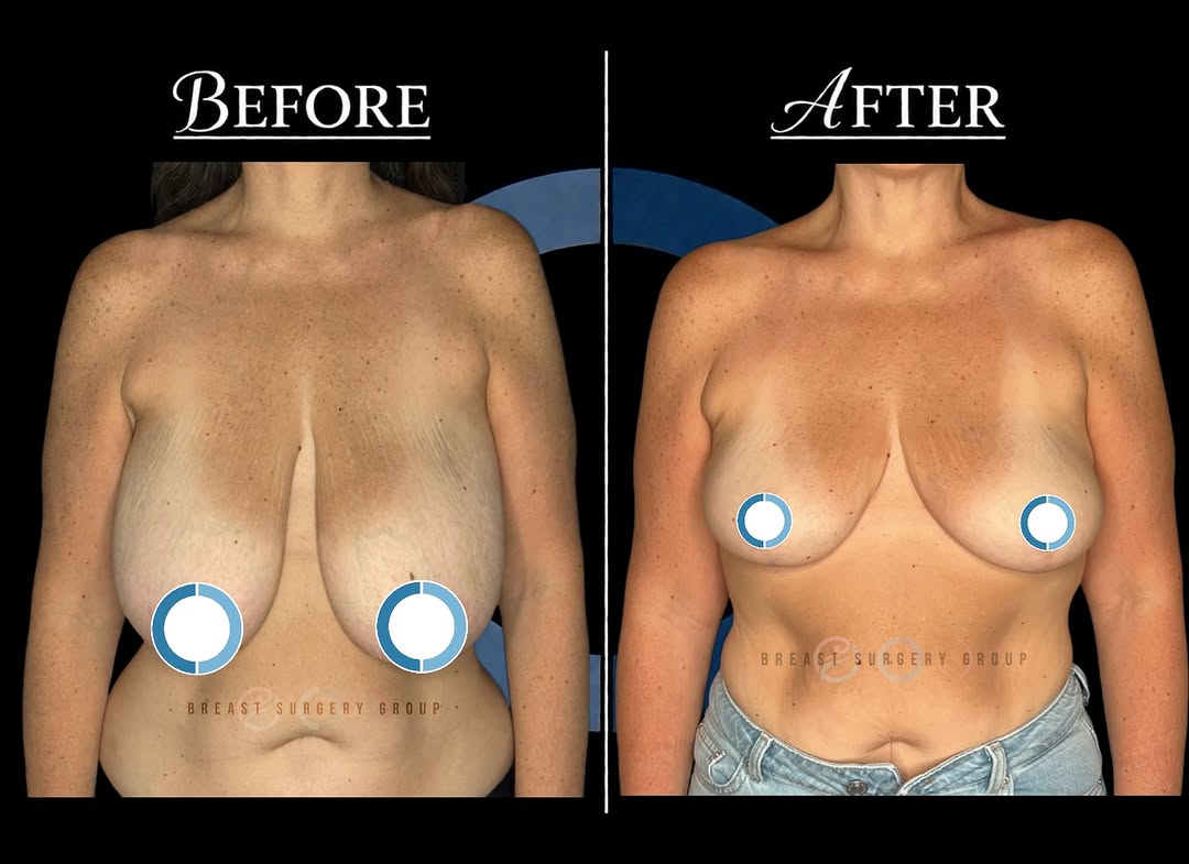 Instagram post by Dr. Keith M. Blechman: Breast reduction surgery is designed to reduce excess breast volume while also reshaping and supporting the remaining tissue for a more bala…