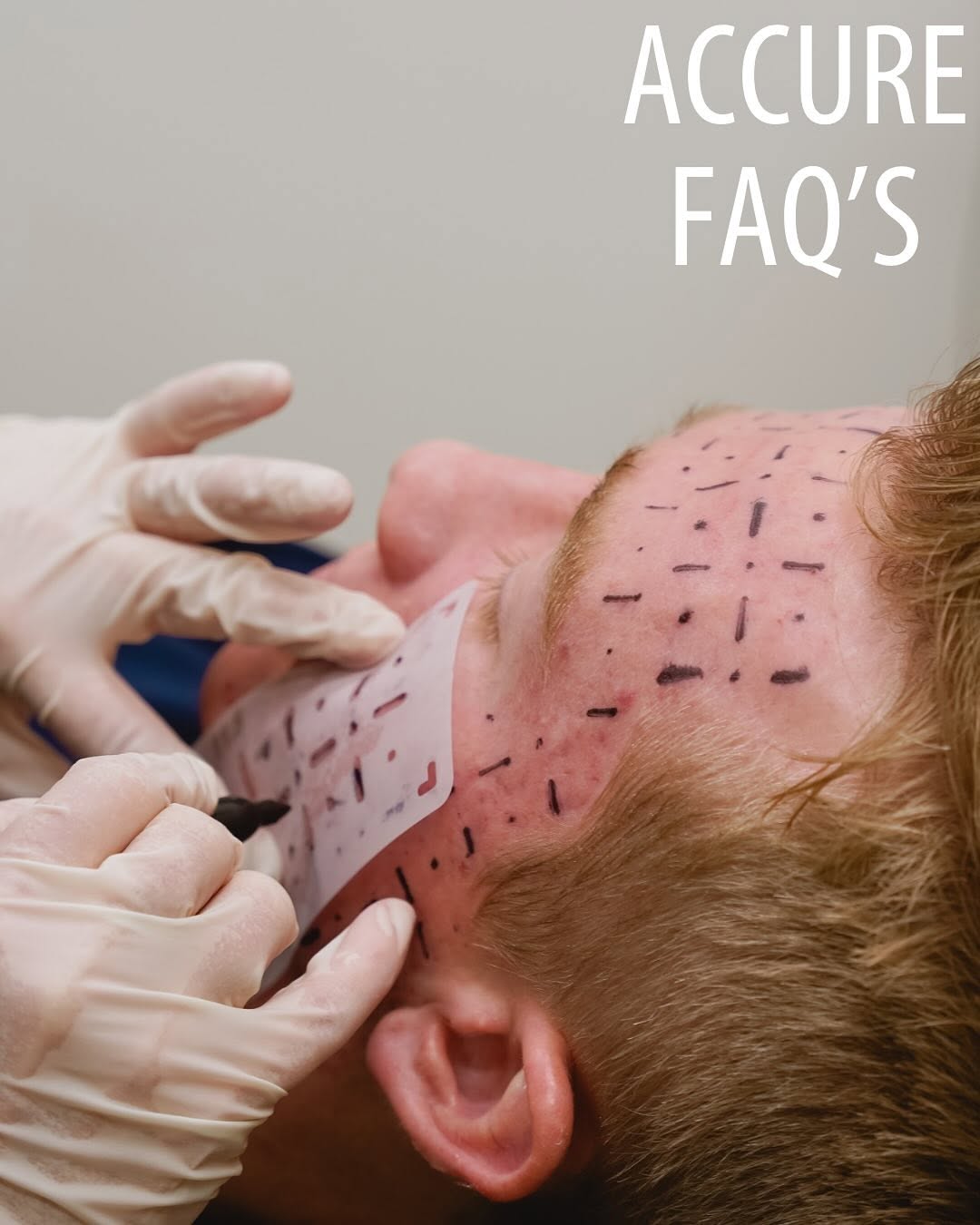 Instagram post by Dr. Kelly Hubbard: Introducing one of our latest treatments at Cache Valley Dermatology – the Accure Acne Laser! This innovative laser targets acne in a whole …