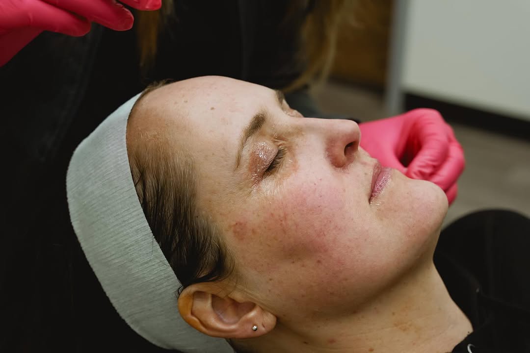 Instagram post by Dr. Kelly Hubbard: Look good feel good, right!! At Cache Valley Dermatology we want you to leave feeling your best. Chemical peels are a great way to get your …
