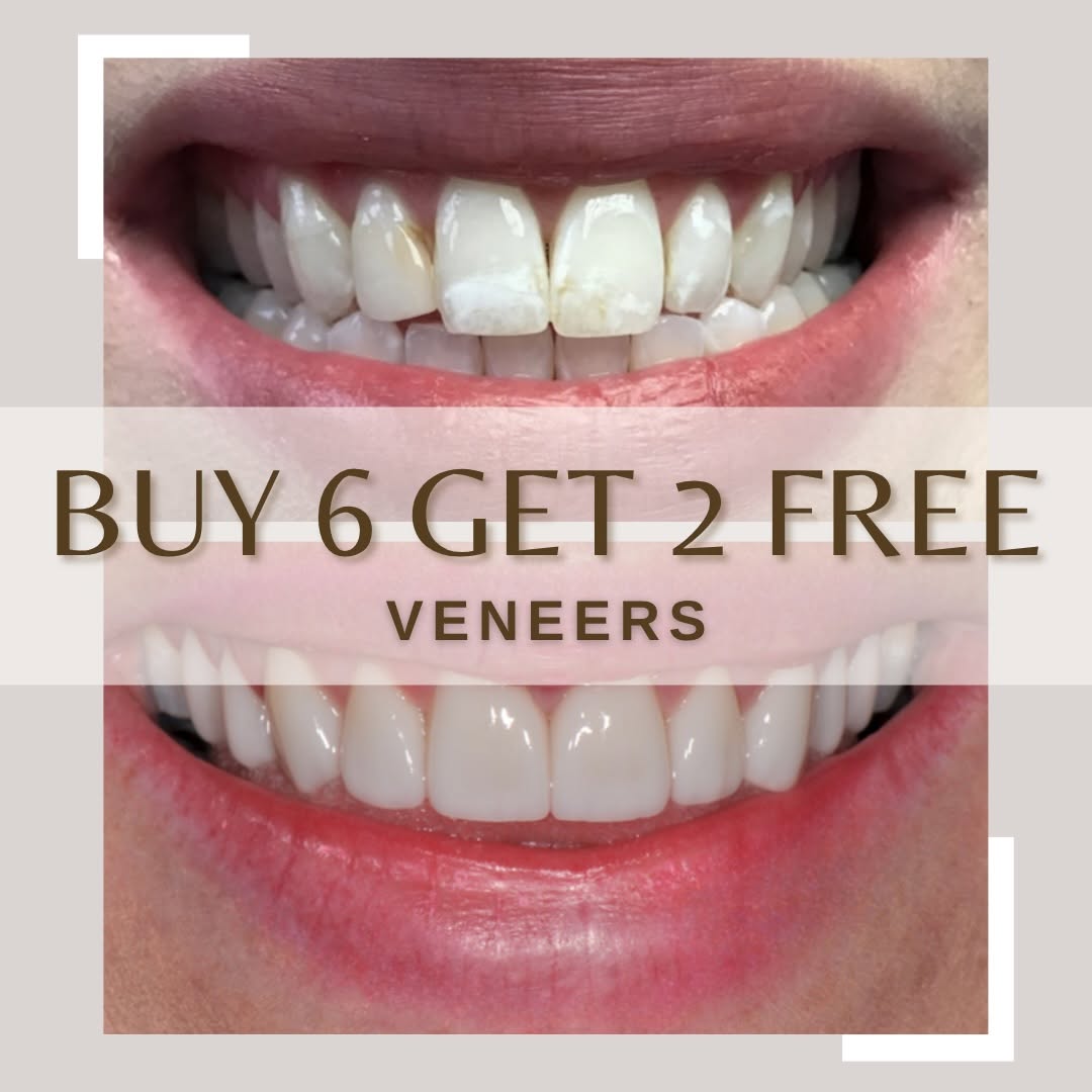 Instagram post by Dr. Ken Cirka, D: ✨ JUNE VENEER SPECIAL ✨ Dreaming of a brighter, more confident smile? Now is the perfect time! 😁 🦷 Buy 6 Veneers, Get 2 FREE 💰 Save Over …