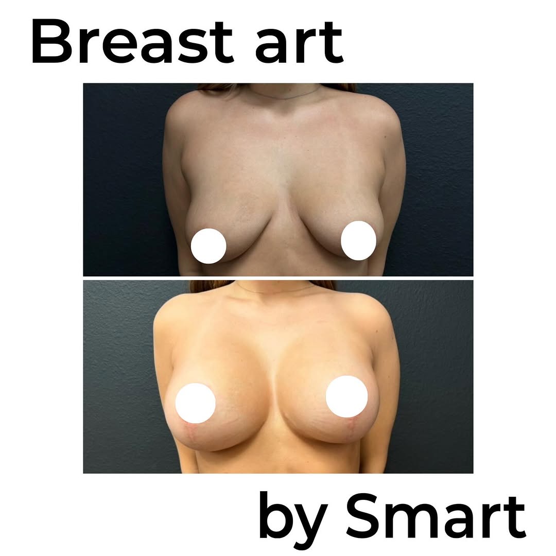 Instagram post by Dr. Ken Smart: She got the look she wanted with breast lift & implants (mastopexy/aug). It’s not uncommon for some young women before having kids to need a…