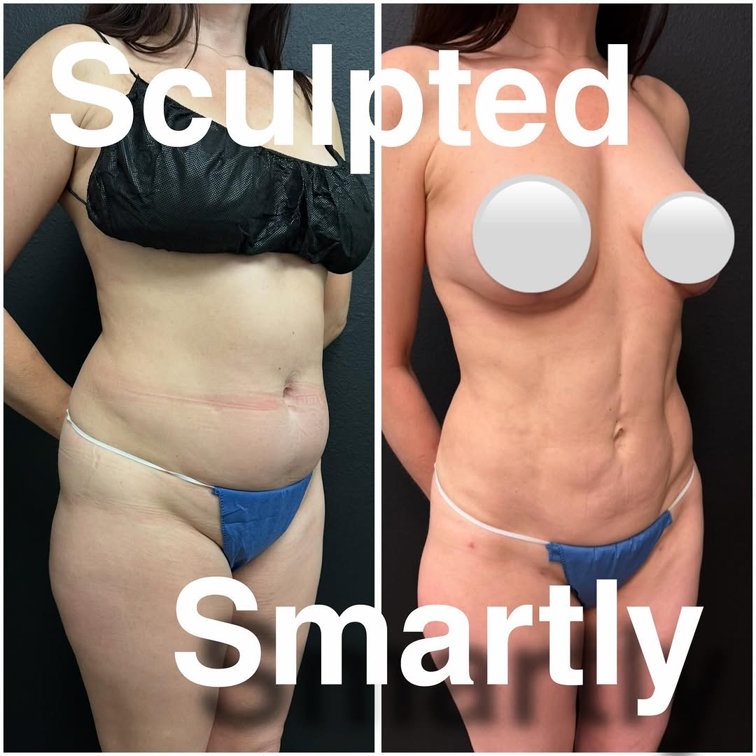 Instagram post by Dr. Ken Smart: Not everyone needs a tummy tuck after having two kids. This 51 year old patient of mine had great skin elasticity after her two pregnancies.…