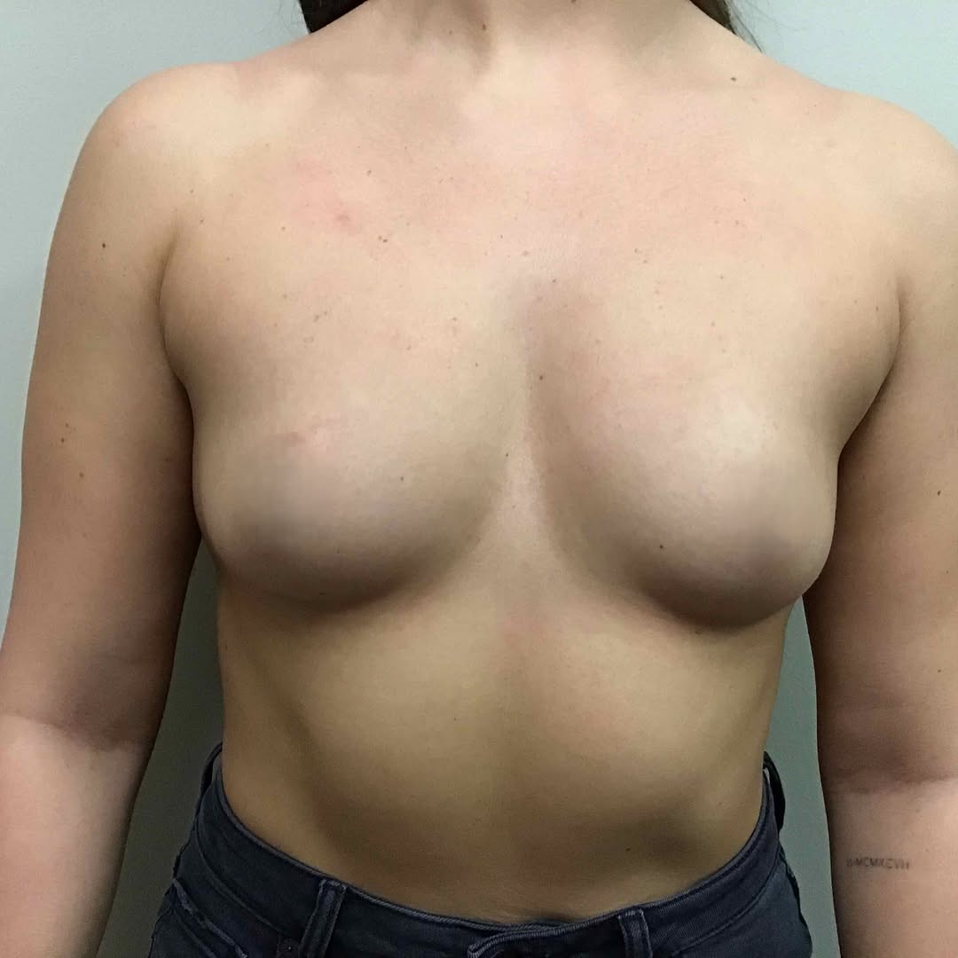 Instagram post by Dr. Kenneth C. Kneessy: Motiva Implants! . . . We’re always looking for ways to give our patients more options when it comes to getting the result they want—and we’…