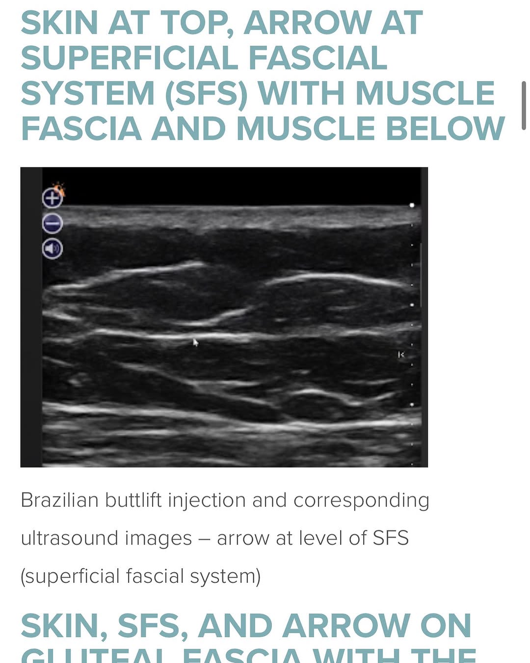 Instagram post by Dr. Kenneth Hughes: Dr. Kenneth Hughes injects directly under skin far away from muscle fascia for the safest Brazilian Buttlift. There is a lot of information …