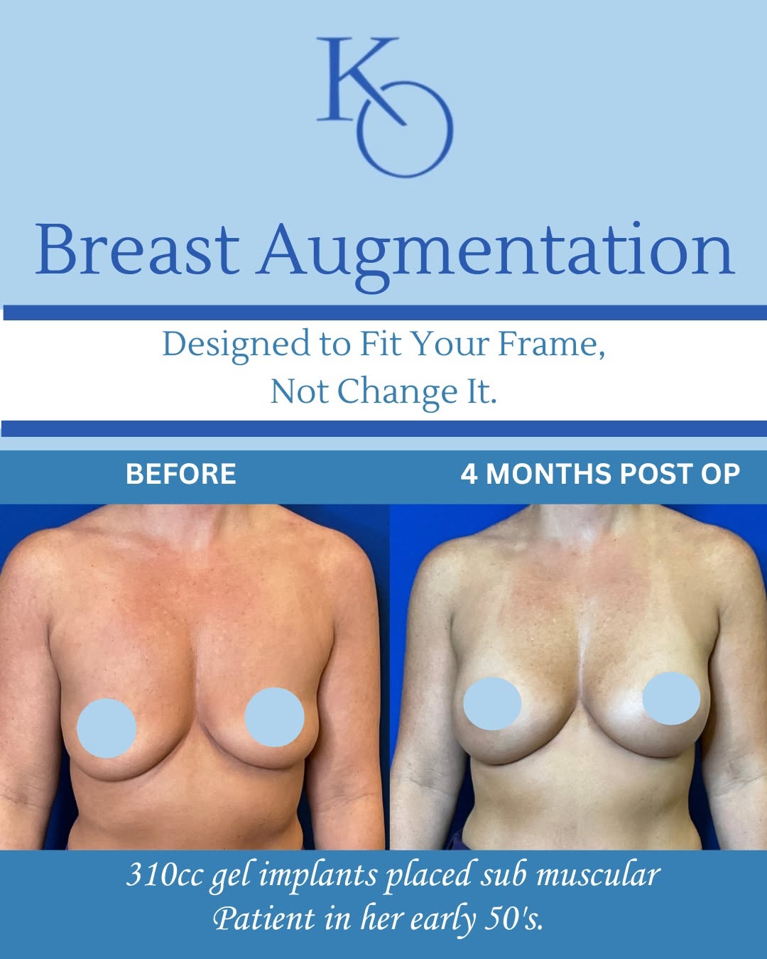 Instagram post by Dr. Kenneth Odinet, DDS: ✨ Designed to Fit Your Frame, Not Change It. ✨ Beautiful breast augmentation isn’t about looking different—it’s about looking like the best …