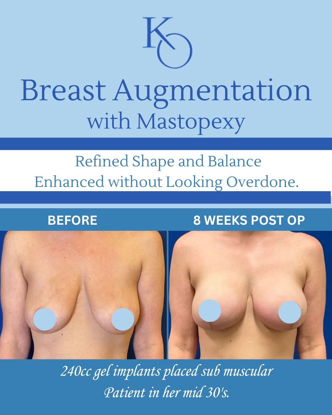 Instagram post by Dr. Kenneth Odinet, DDS: Do I need an Implant with my Breast Lift? Not always. A mastopexy can be performed alone, but sometimes a small implant can restore lost vol…