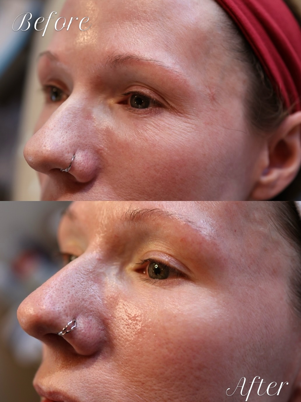 Instagram post by Dr. Kenneth Oleszek: We love a good before and after 😜 Here’s what she did👇 Treatment: Tixel Treatment Area: upper/lower eyelids + above the brow + on the peri…