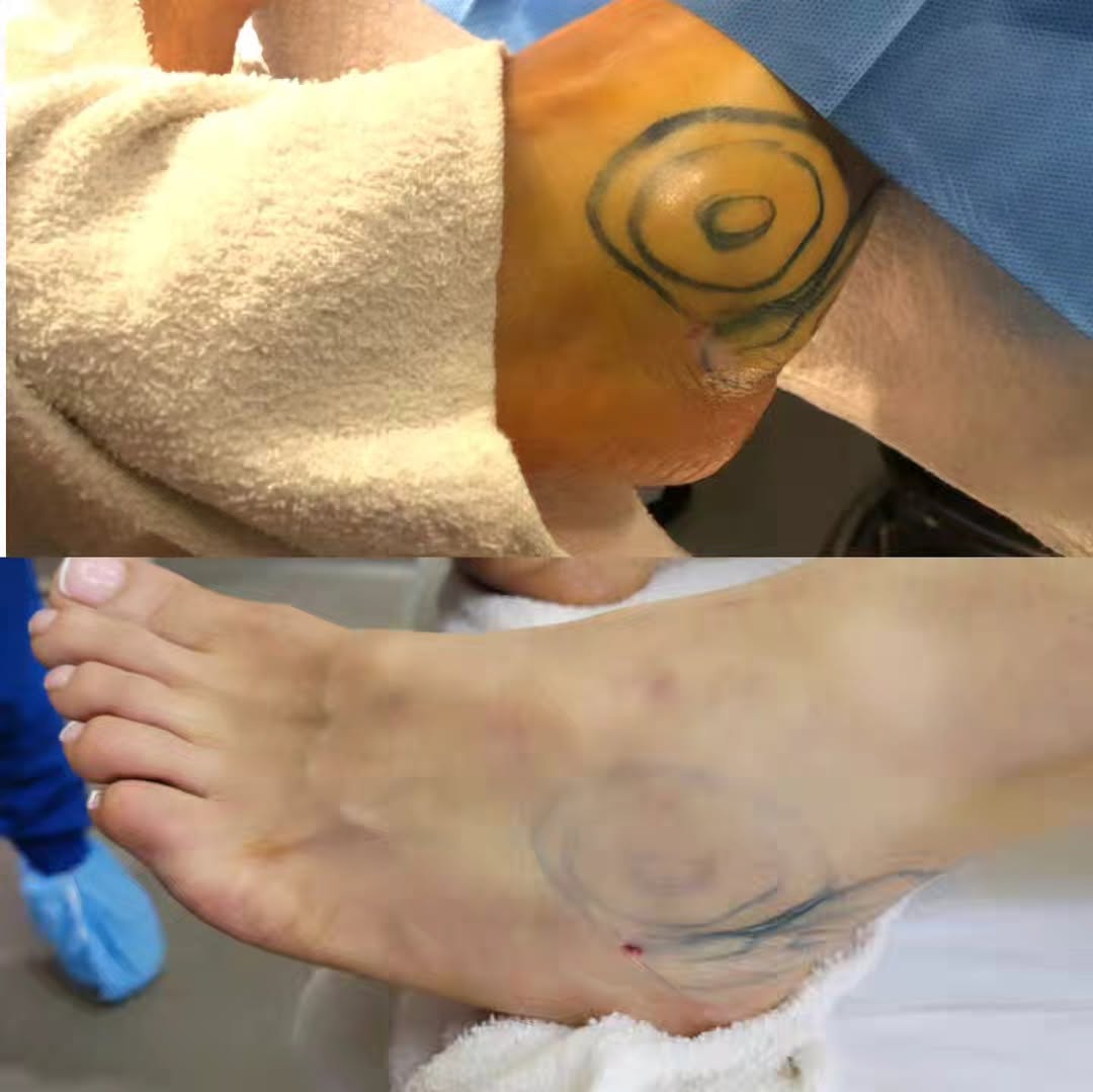 Instagram post by Dr. Kenneth R. Francis: What does summer ready mean for you? Well to this patient it meant contouring her ankles to look better. Fat pockets can be anywhere we don'…