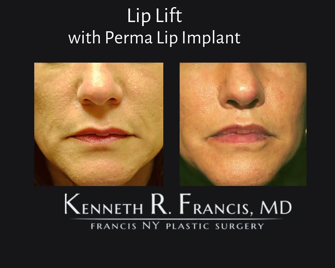 Instagram post by Dr. Kenneth R. Francis: Did you ever want fuller lips without having to use a filler. There is an option for you Perma Lip Filler! This patient also had a lip lift.…