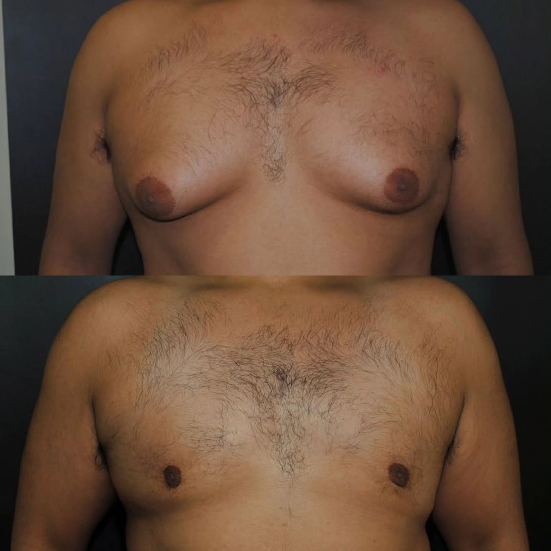 Instagram post by Dr. Kenneth R. Francis: Gynecomastia can be very embarrassing for some There are procedures out there to help reduce the size. There is still enough time before sum…
