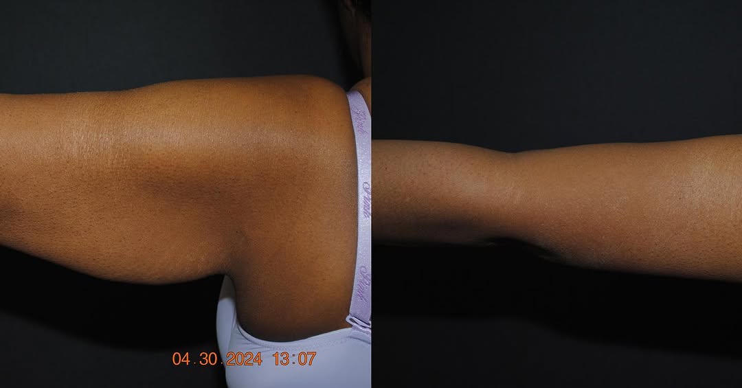 Instagram post by Dr. Kenneth R. Francis: Let the New Year be a new YOU 🥳 WOW! Our patient is extremely happy with her Arm Lift results. What is an Arm Lift? An Arm lift or Brachiop…
