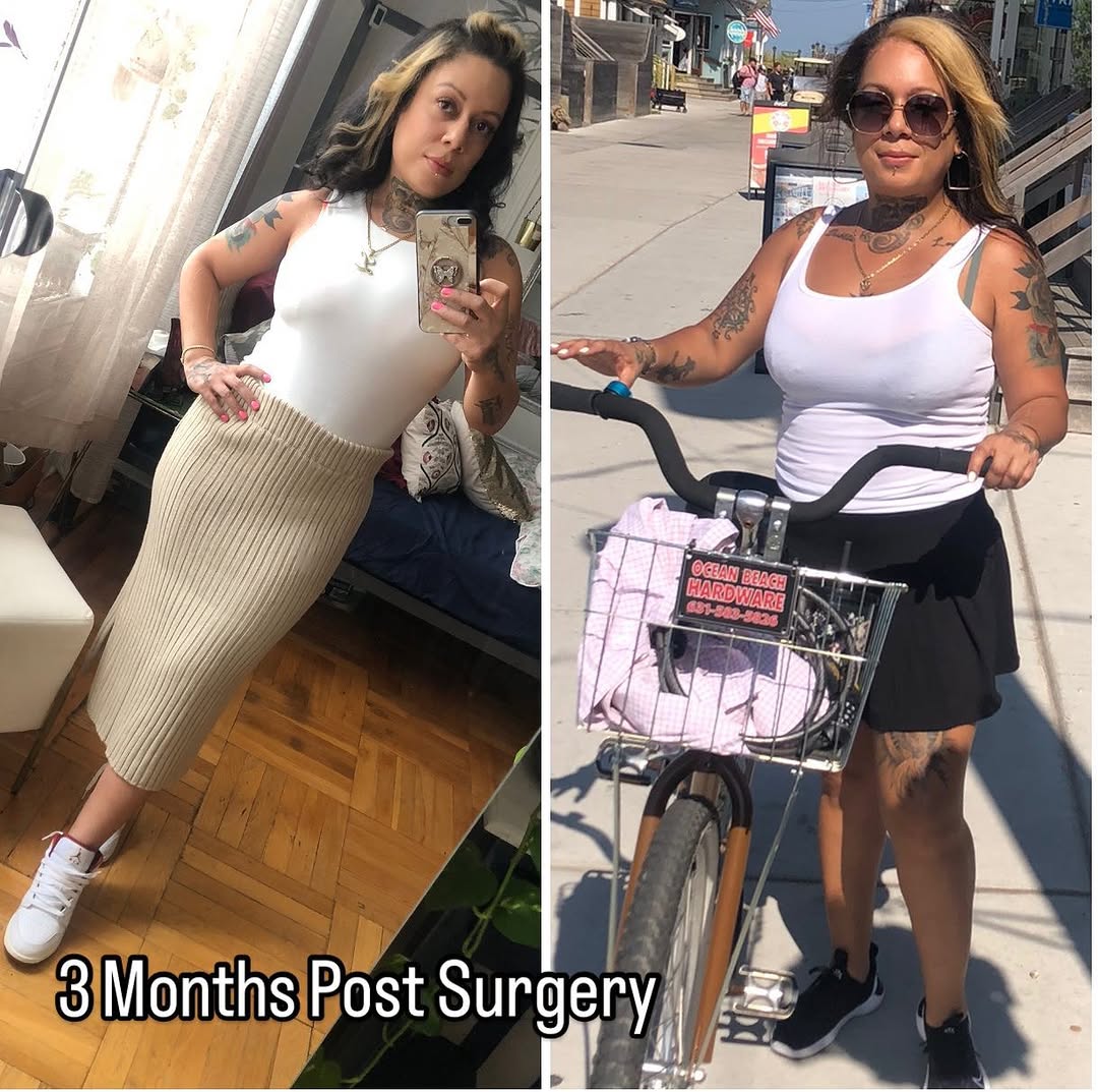 Instagram post by Dr. Kenneth R. Francis: Make your NEW YEARS RESOLUTION come true this year. 3 months post surgery, Tummy Tuck & Liposuction. Thank you Dr Francis for this new chapt…