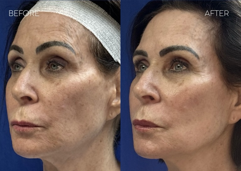 Instagram post by Dr. Kenneth Rothaus: Reduced sun damage, improved tone + texture, and skin tightening all after a single laser treatment! ⚡️ This innovative approach is used wit…