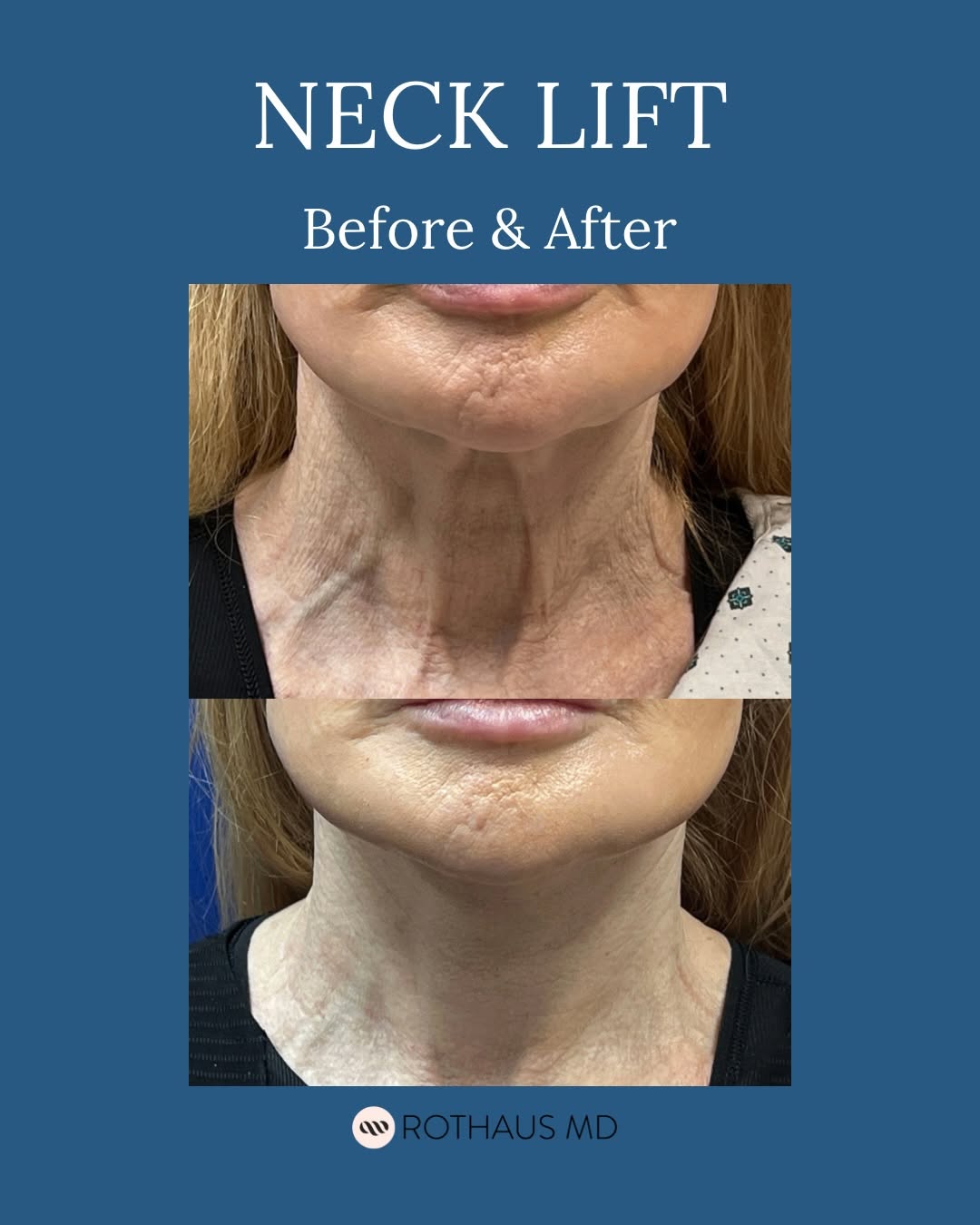 Instagram post by Dr. Kenneth Rothaus: One week post-op photos demonstrates an evident change and very little downtime. This patient underwent a neck lift under local anesthesia: …