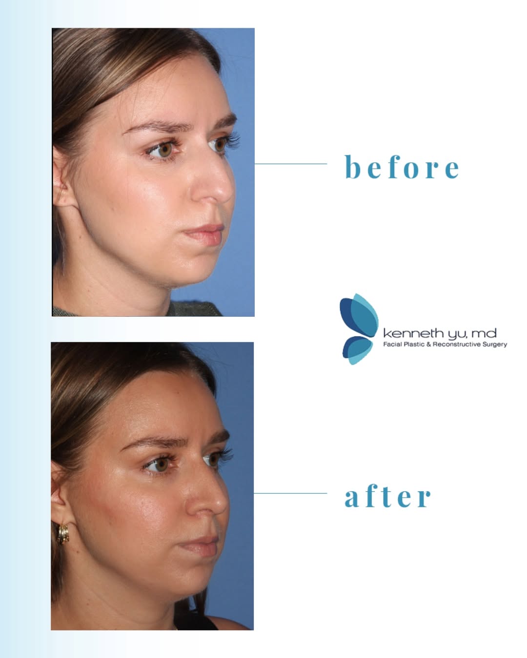Instagram post by Dr. Kenneth Yu: A beautiful example of how subtle, thoughtful changes can create a harmonious and balanced result. This rhinoplasty focused on refining the …