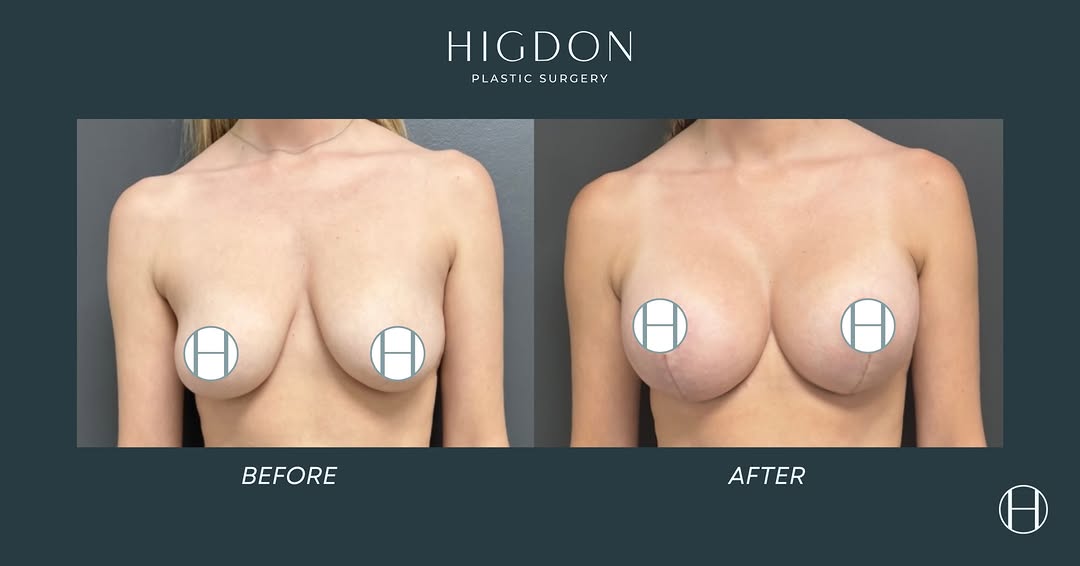 Instagram post by Dr. Kent (Kye) Higdon: A lift + added volume for a beautiful, balanced result. ✨ This patient underwent a breast augmentation with lift using Motiva Round Mini 360…