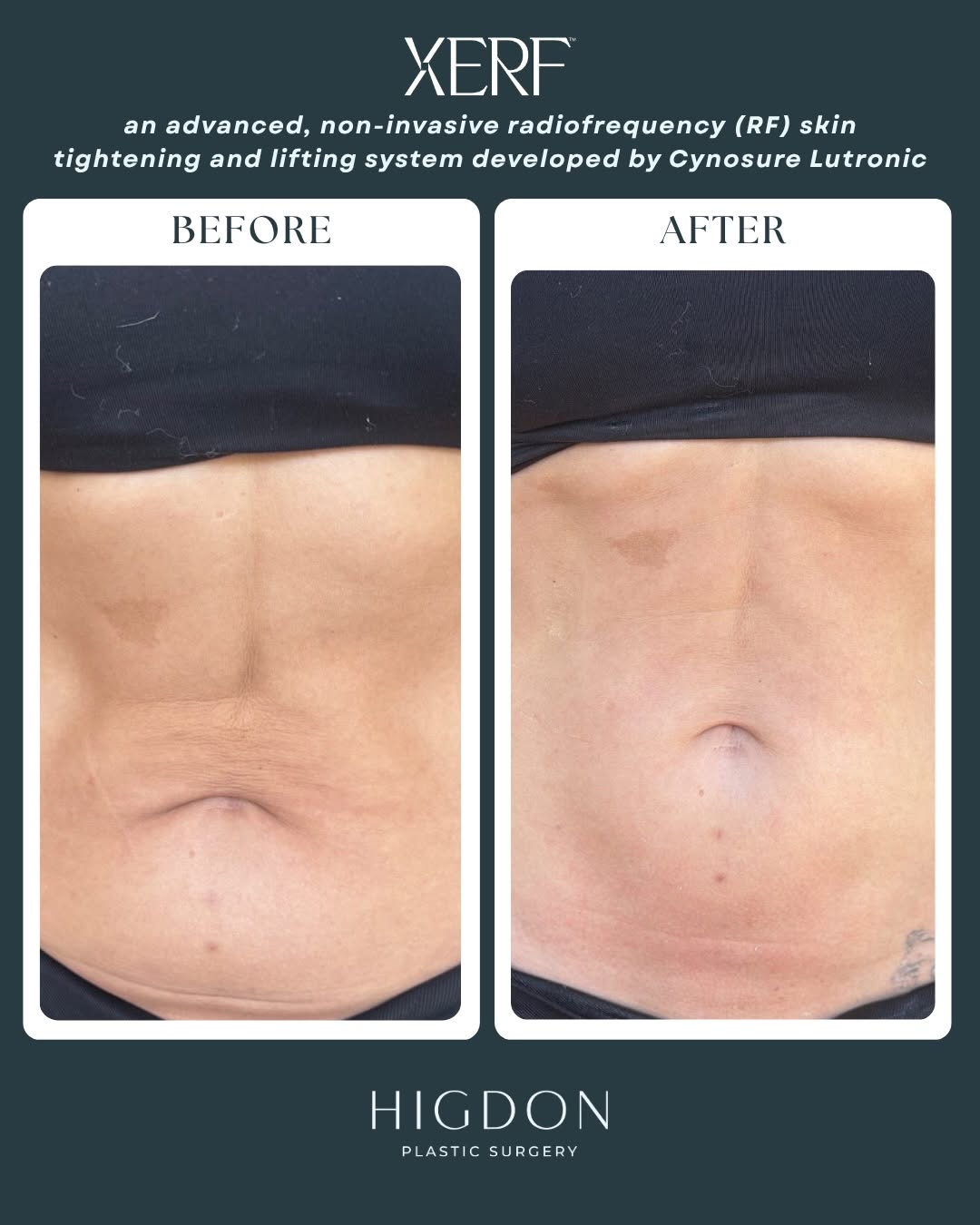 Instagram post by Dr. Kent (Kye) Higdon: XERF isn’t just for the face. 👀 These before & afters show what this non-invasive radiofrequency treatment can do for skin laxity on the ab…
