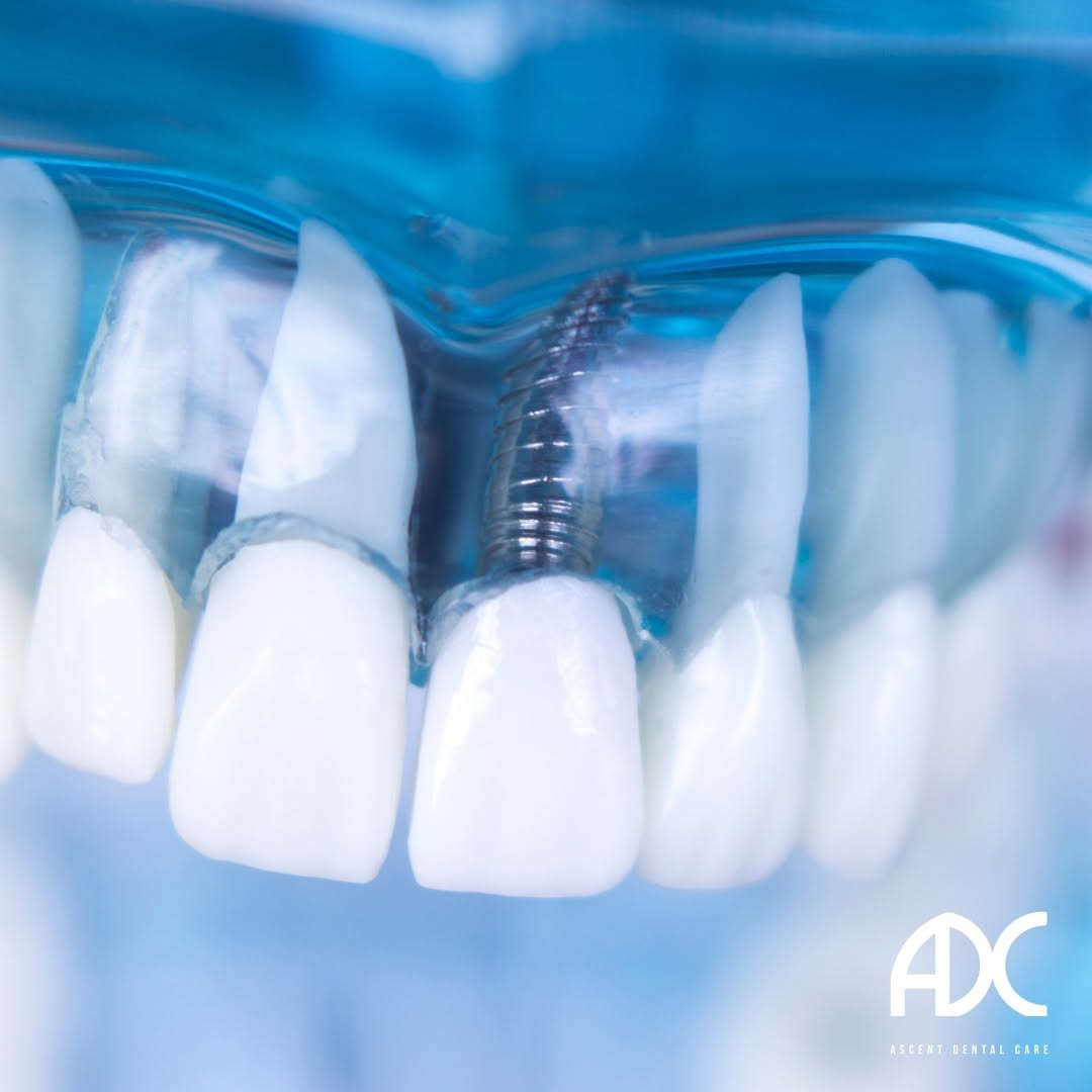 Instagram post by Dr. Kevin Coughlin, D: Missing a tooth? 🦷 Restore your smile with our single-tooth implant service! Get a natural look and feel with a durable, long-lasting solut…