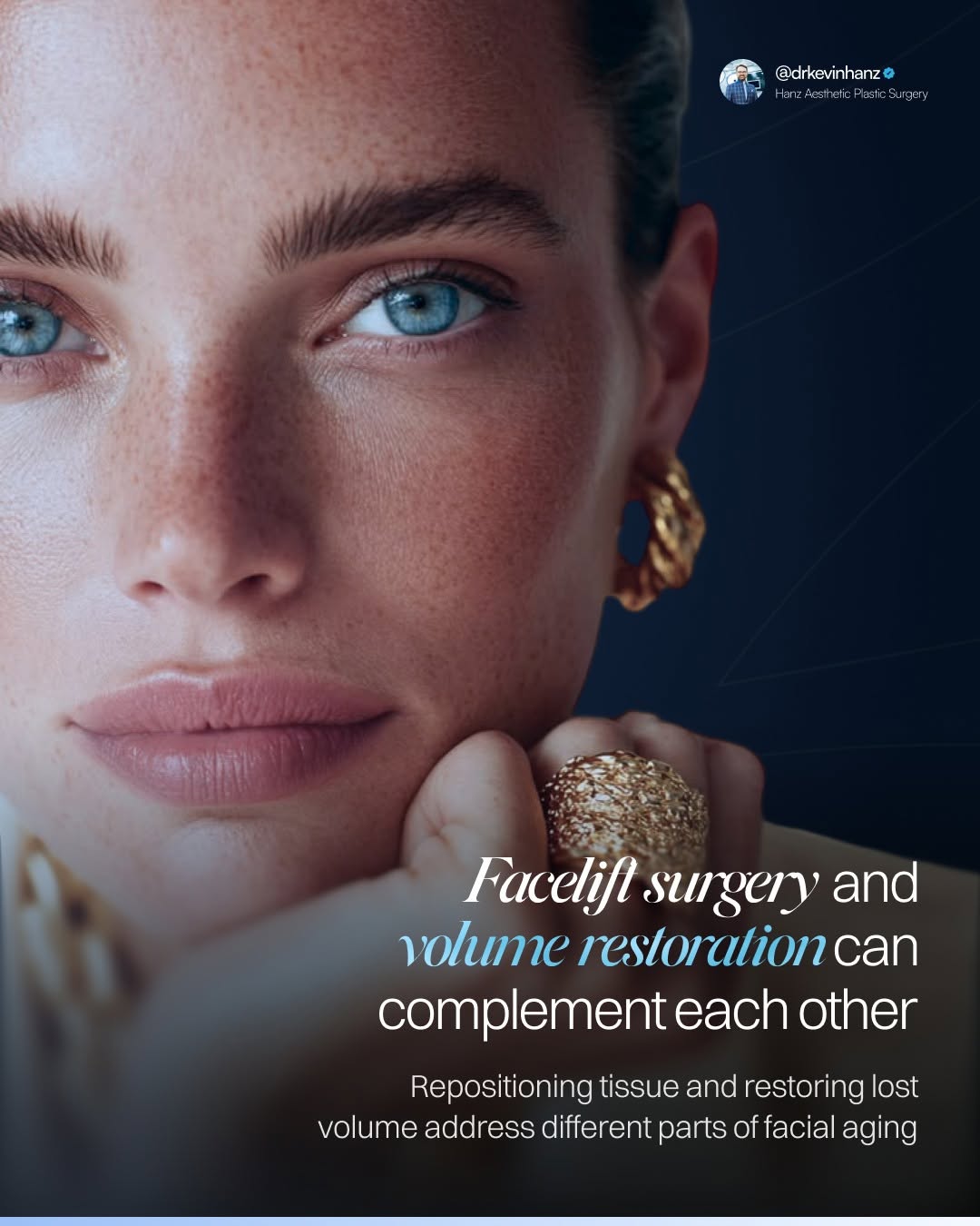 Instagram post by Dr. Kevin R. Hanz: When I evaluate facial aging, I am looking at more than whether tissues have descended. I am also paying attention to where the face has gra…