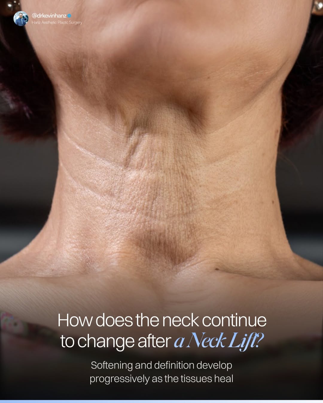 Instagram post by Dr. Kevin R. Hanz: The neck often continues changing well after the most visible signs of early recovery have improved. Initially, the tissues can feel firm or…