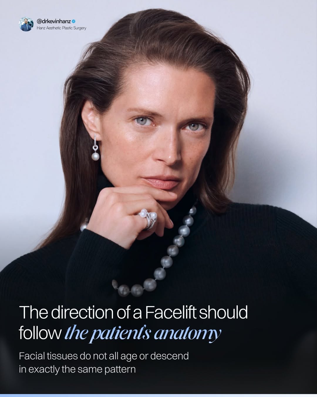 Instagram post by Dr. Kevin R. Hanz: When I perform a Deep Plane Facelift, I do not think about simply pulling the face upward. Every face ages differently. One patient may have…