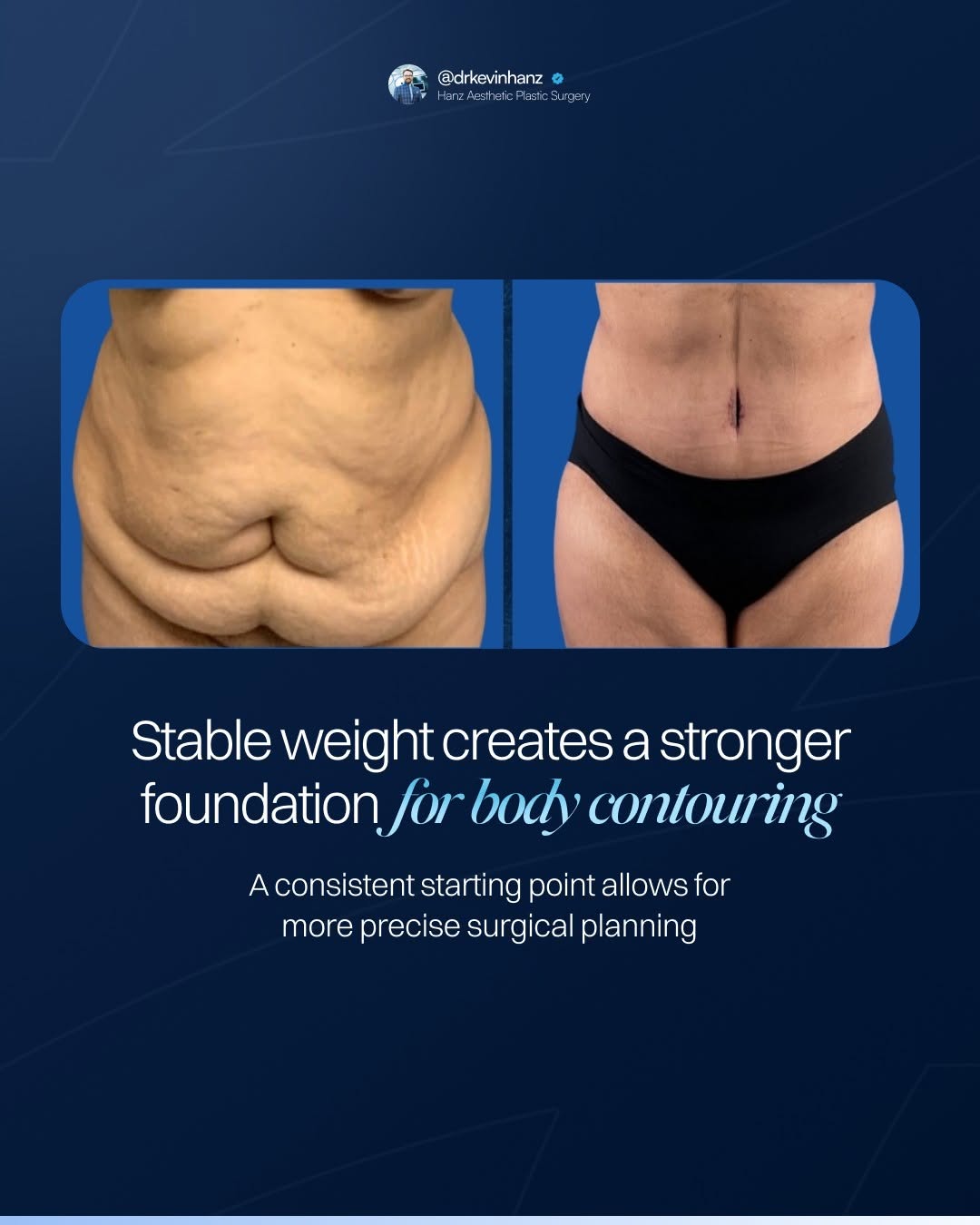 Instagram post by Dr. Kevin R. Hanz: After a major weight-loss journey, reaching a more stable weight gives me a much clearer picture of the tissues I will actually be treating.…