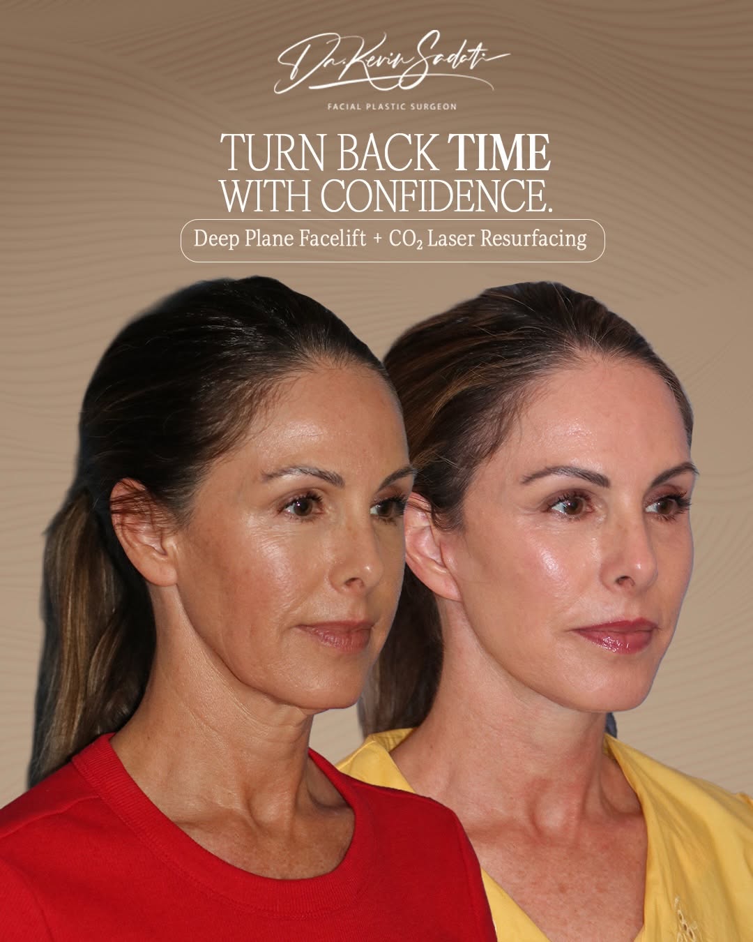 Instagram post by Dr. Kevin Sadati: At 51 years young, my patient wanted to refresh her appearance while maintaining the natural features that make her look like herself. I per…
