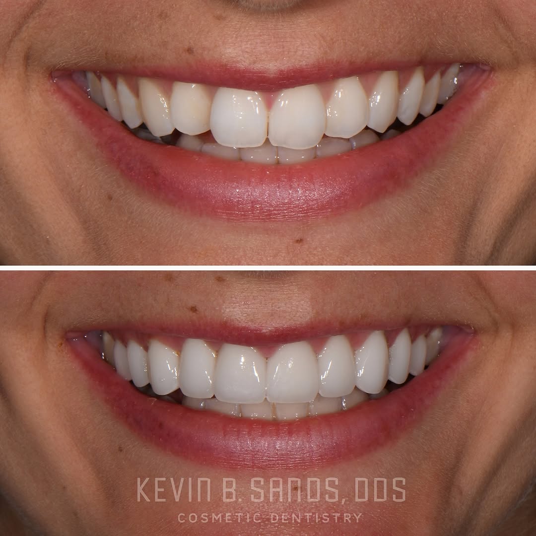 Instagram post by Dr. Kevin Sands, DDS: This patient desired a brighter, more balanced smile while maintaining her natural character. Porcelain veneers were used to refine shape, c…