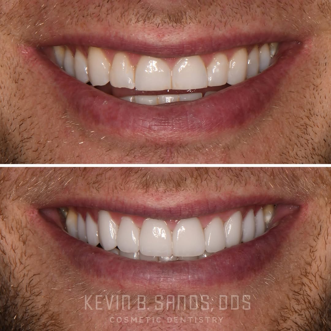 Instagram post by Dr. Kevin Sands, DDS: In this case, the teeth were significantly worn down over time, leading to shortened edges and uneven proportions. Through thoughtful smile …