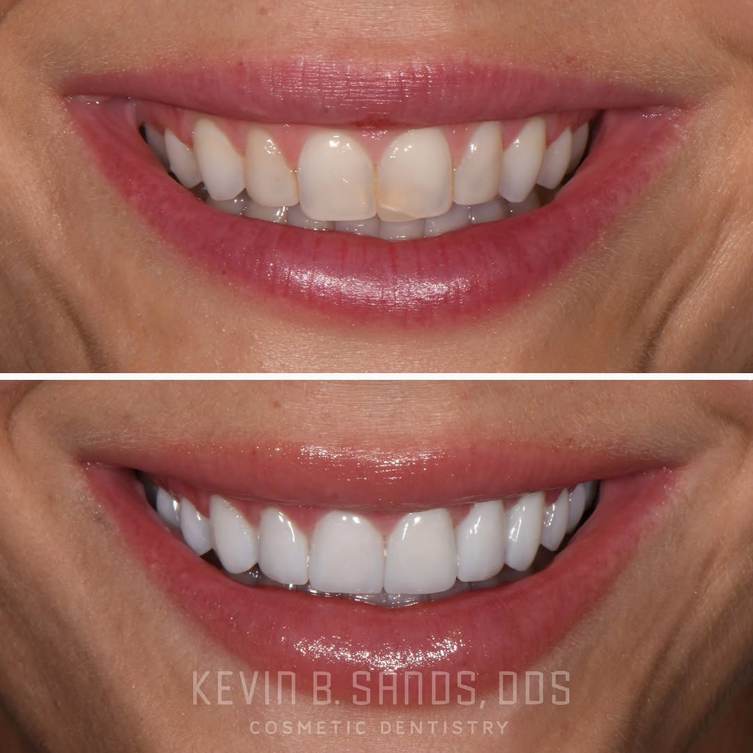 Instagram post by Dr. Kevin Sands, DDS: In this case, we corrected uneven tooth edges, refined the tooth shapes, improved color consistency, and enhanced the overall balance of the…