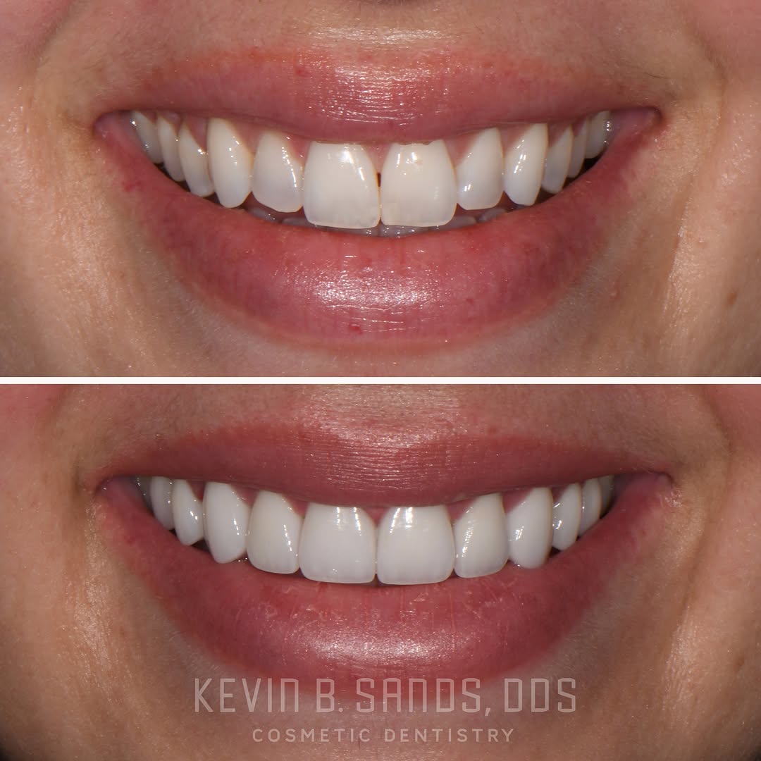 Instagram post by Dr. Kevin Sands, DDS: Crafting smiles is more than dentistry, it’s art with purpose. Every detail, every contour, every shade is designed with intention-because c…
