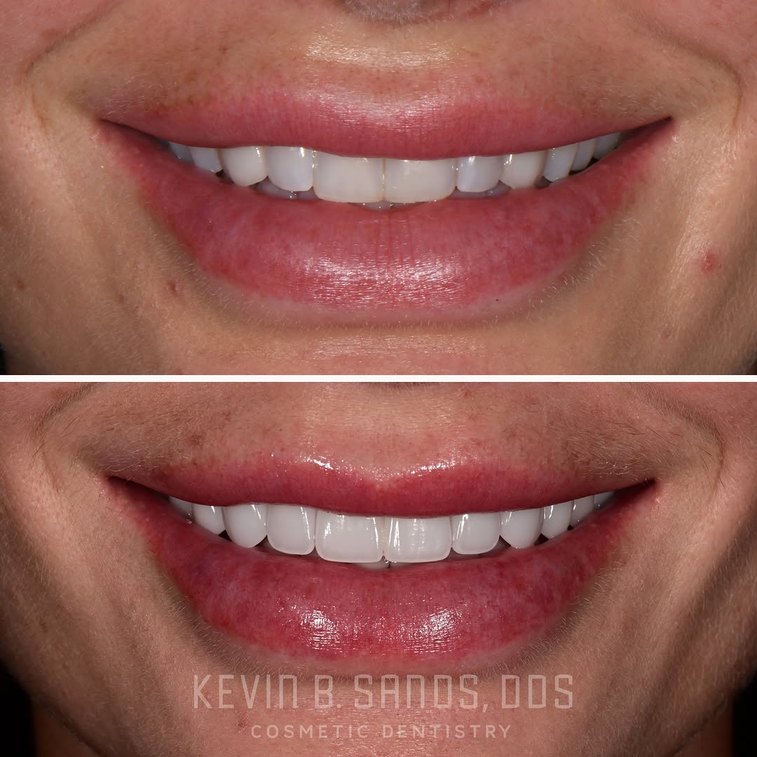 Instagram post by Dr. Kevin Sands, DDS: A smile transformation shouldn’t erase character—it should refine it. Every detail of this smile was designed around the patient: preserving…