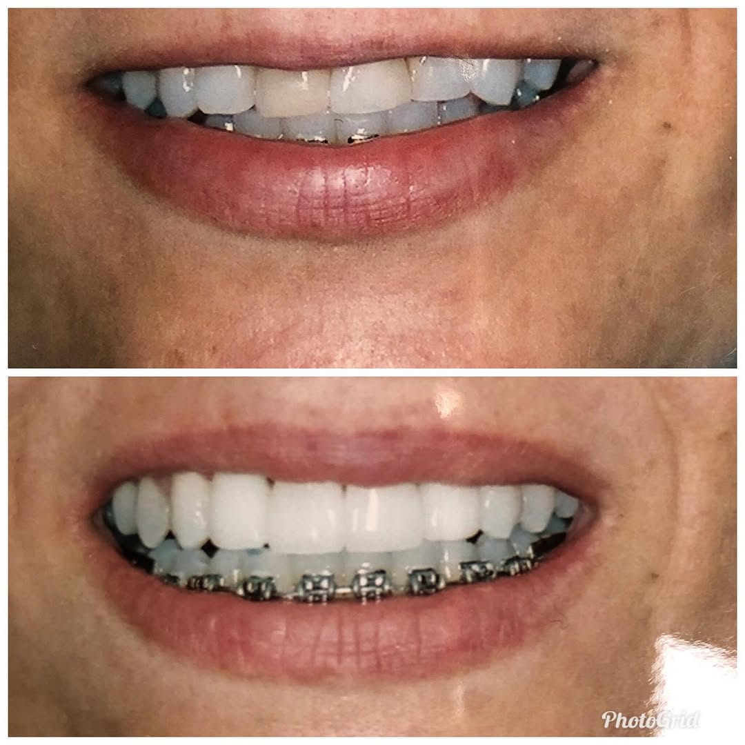 Instagram post by Dr. Khalil S. Saghezchi, DDS: Minimal prep porcelain veneers 🦷 This patient came to see me as an emergency patient for tooth pain while in California from out of town. S…