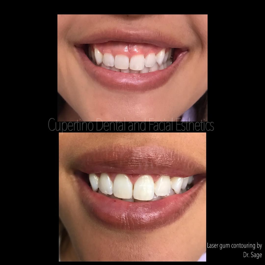 Instagram post by Dr. Khalil S. Saghezchi, DDS: A beautiful transformation with just laser gum contouring. No down time No pain Can be done in less than 1 hour . For appointment inquiries …