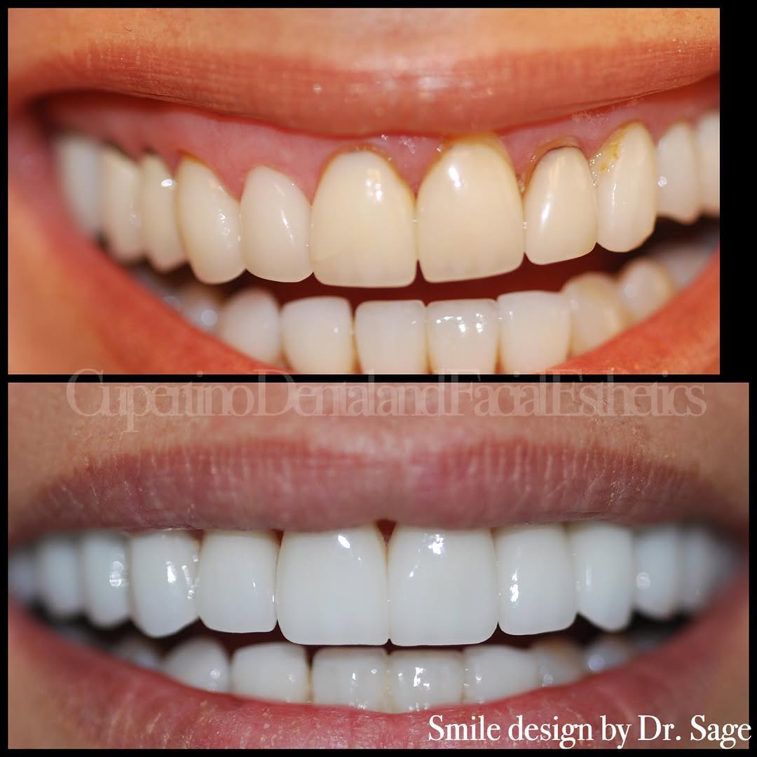 Instagram post by Dr. Khalil S. Saghezchi, DDS: This patient had veneers done 24 years ago and while the veneers held up well, esthetically and functionally she was ready for a new set. Be…