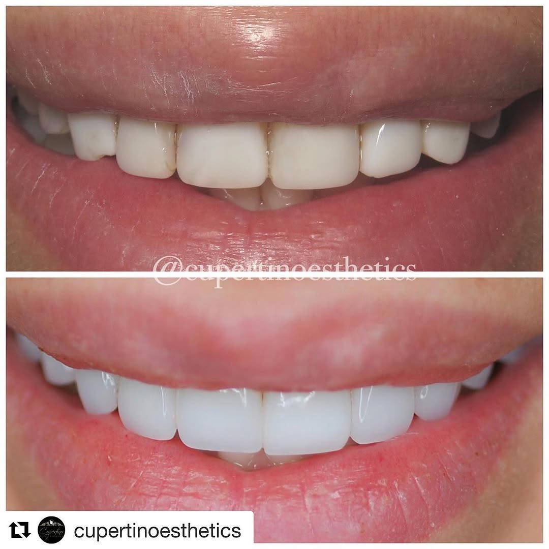 Instagram post by Dr. Khalil S. Saghezchi, DDS: #Repost @cupertinoesthetics with @get_repost ・・・ My official 2019 smile makeover, and long time goal, completed by my 2 favorite dentists @s…