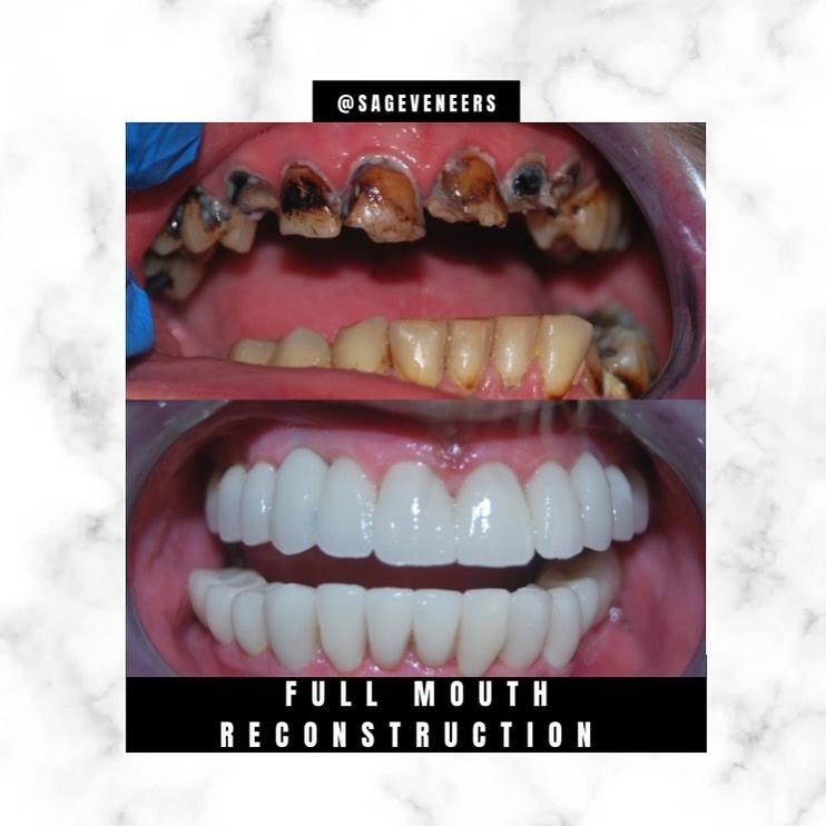 Instagram post by Dr. Khalil S. Saghezchi, DDS: In honor of National Doctor’s Day we wanted to show this amazing before and after. This patient came to Dr. Saghezchi for a full mouth recon…