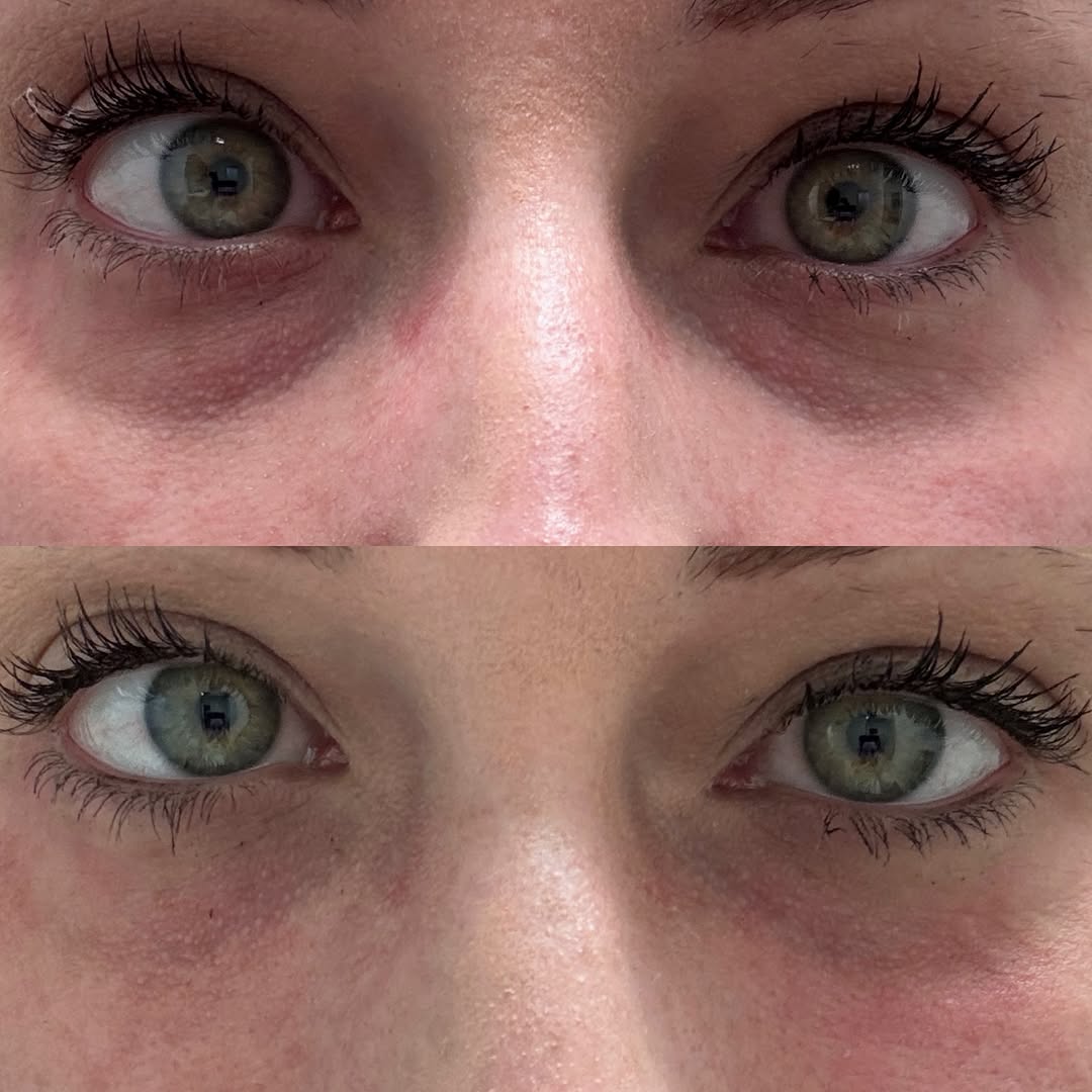 Instagram post by Dr. Khurram Rashid: ✨ Look Rested—Even When You’re Not! ✨ Under-eye filler can help restore lost volume and soften hollowness and shadows that make you look tir…