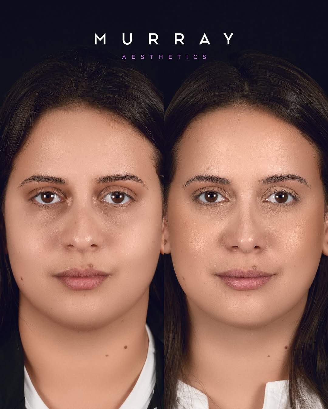 Instagram post by Dr. Kim Patrick Murray: Primary rhinoplasty performed in 9-2022. ⚠️ATTENTION⚠️ Any negative commentary directed towards the patient will result in immediate block. …