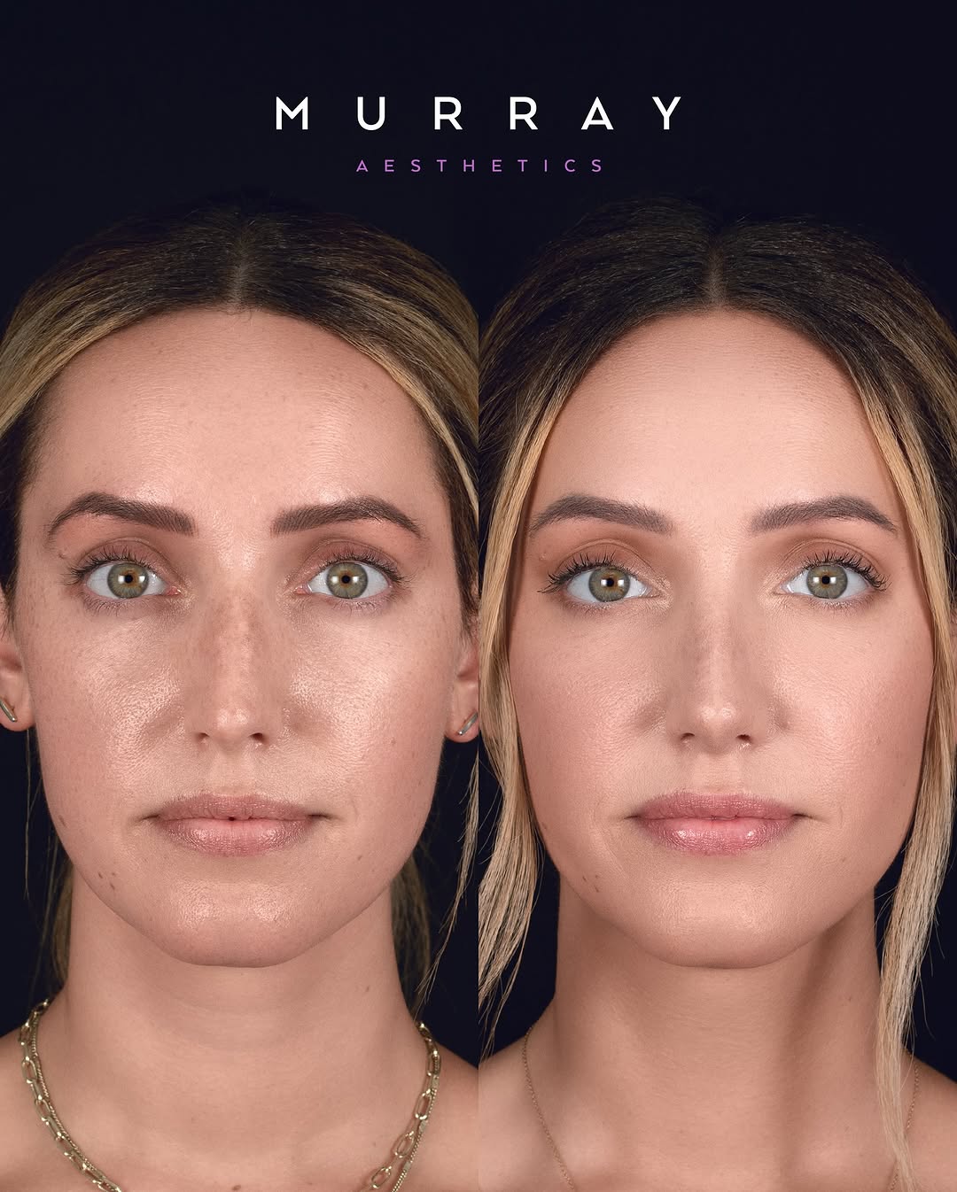 Instagram post by Dr. Kim Patrick Murray: Primary rhinoplasty performed in 9-2022. ⚠️ATTENTION⚠️ Any negative commentary directed towards the patient will result in immediate block. …