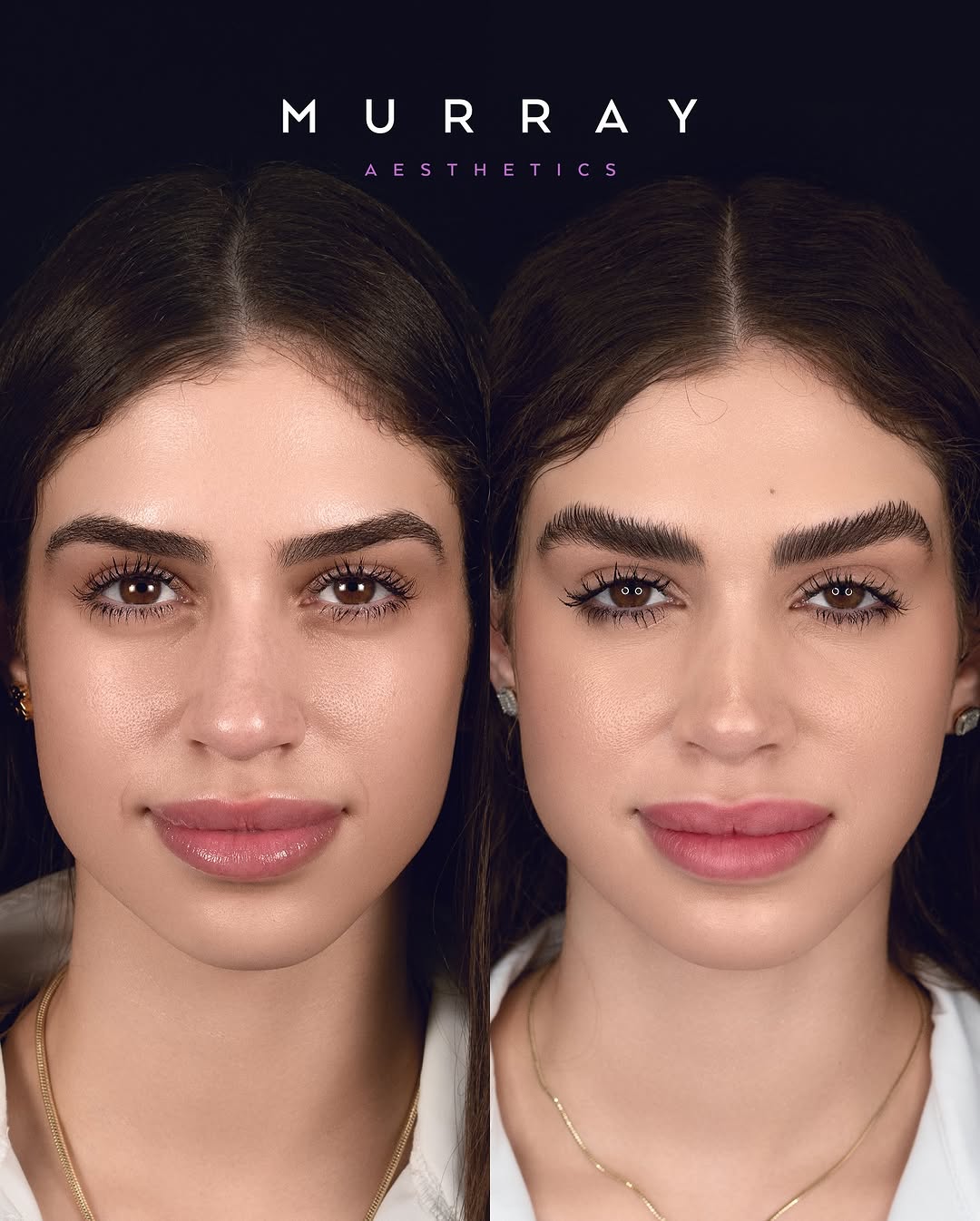 Instagram post by Dr. Kim Patrick Murray: Primary rhinoplasty performed in 4-2023. ⚠️ATTENTION⚠️ Any negative commentary directed towards the patient will result in immediate block. …