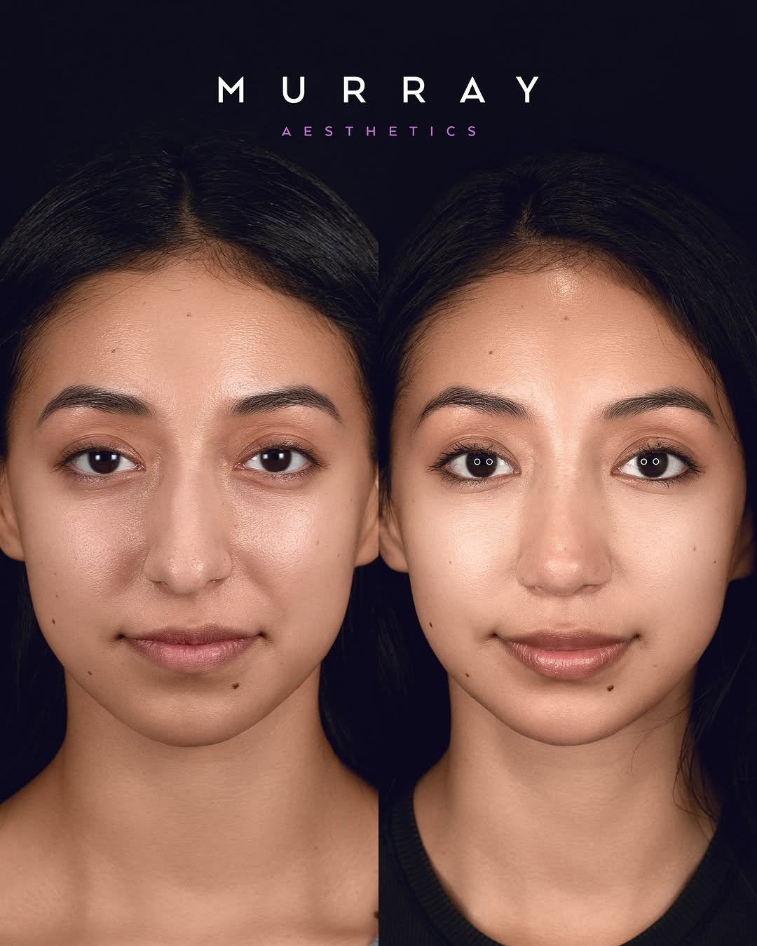 Instagram post by Dr. Kim Patrick Murray: Primary rhinoplasty performed in 1-2023. ⚠️ATTENTION⚠️ Any negative commentary directed towards the patient will result in immediate block. …