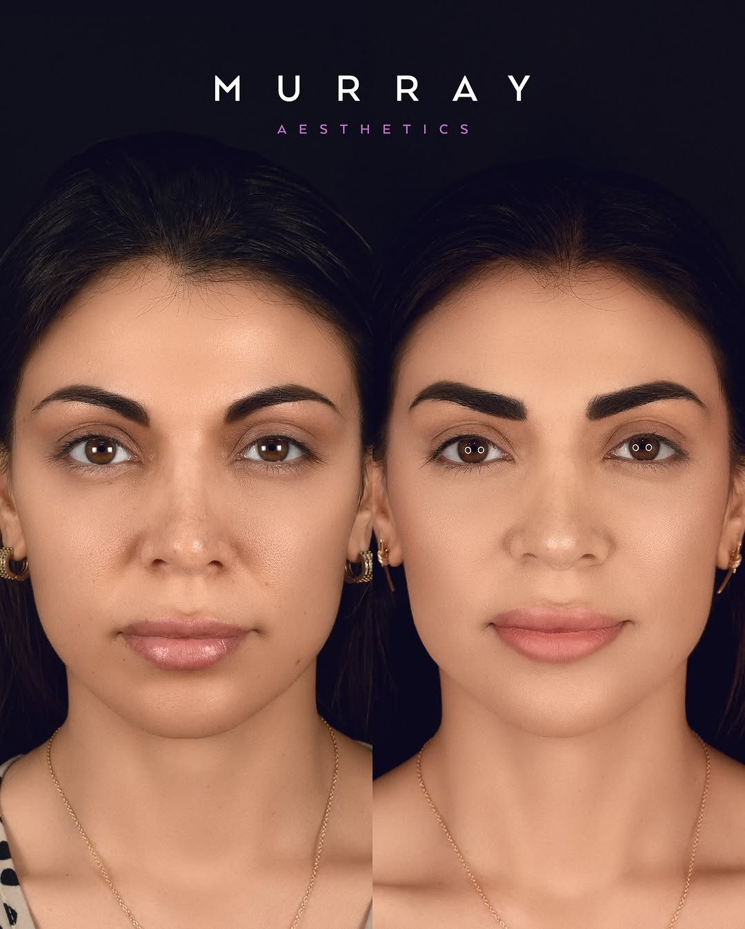 Instagram post by Dr. Kim Patrick Murray: Revision rhinoplasty performed in 2-2023. ⚠️ATTENTION⚠️ Any negative commentary directed towards the patient will result in immediate block.…