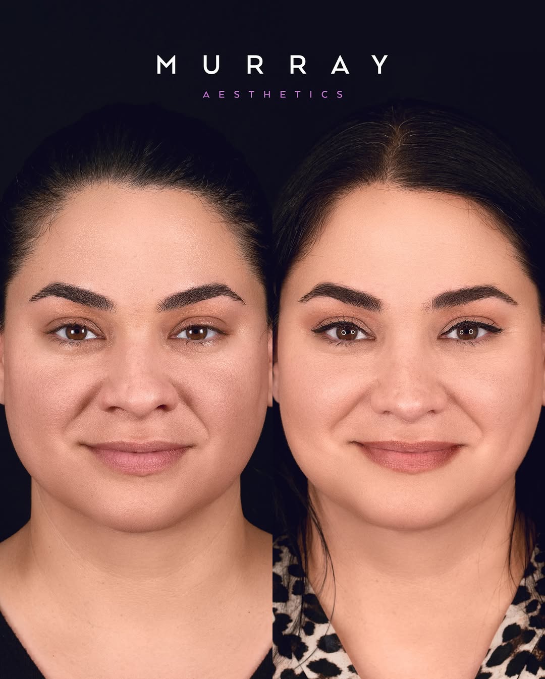 Instagram post by Dr. Kim Patrick Murray: Primary rhinoplasty performed in 4-2023. ⚠️ATTENTION⚠️ Any negative commentary directed towards the patient will result in immediate block. …